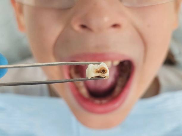 Best Emergency Tooth Extraction in Boalsburg, PA